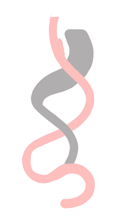 Cirurgia bariátrica pela técnica Bypass 